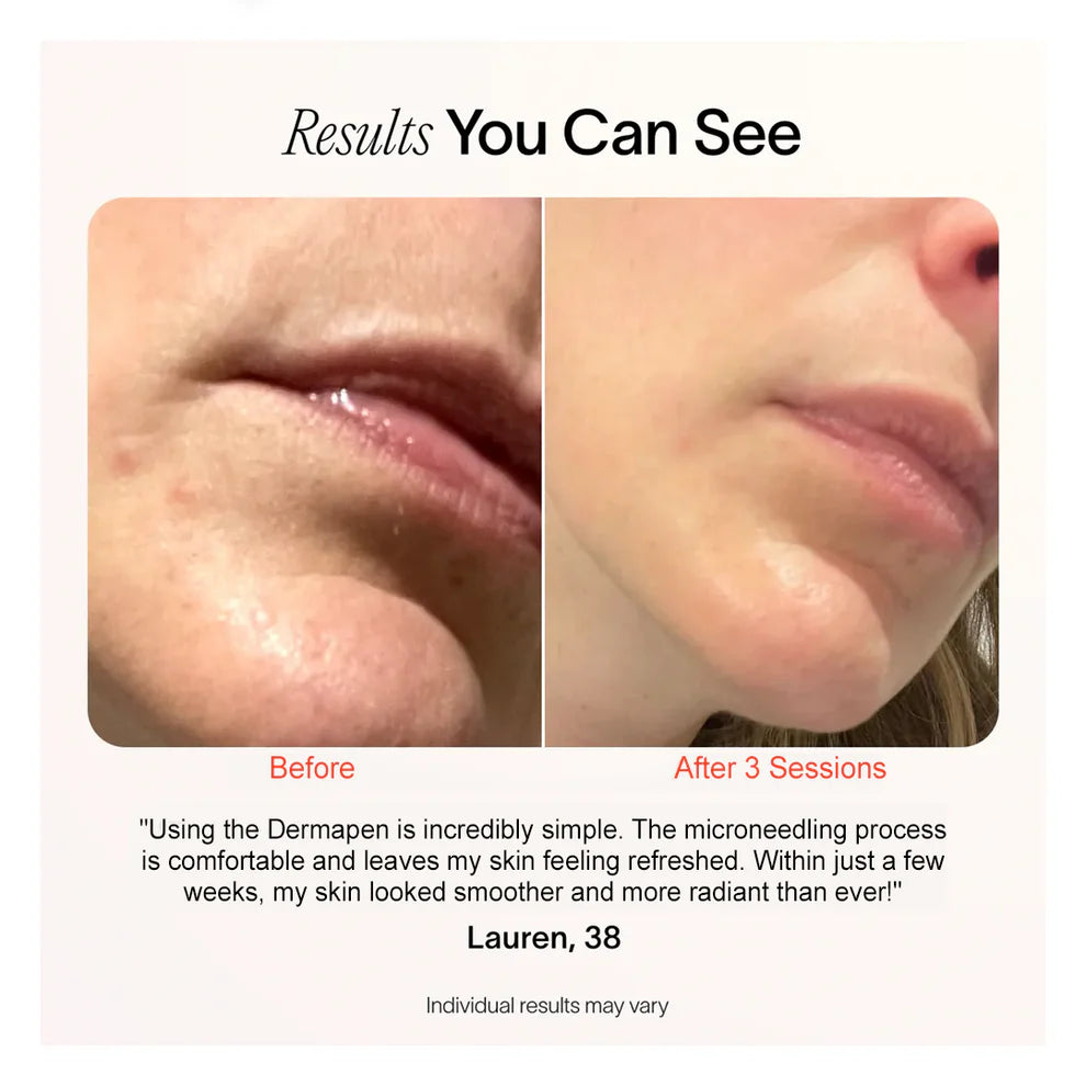 Elixir™Microneedling Dermapen